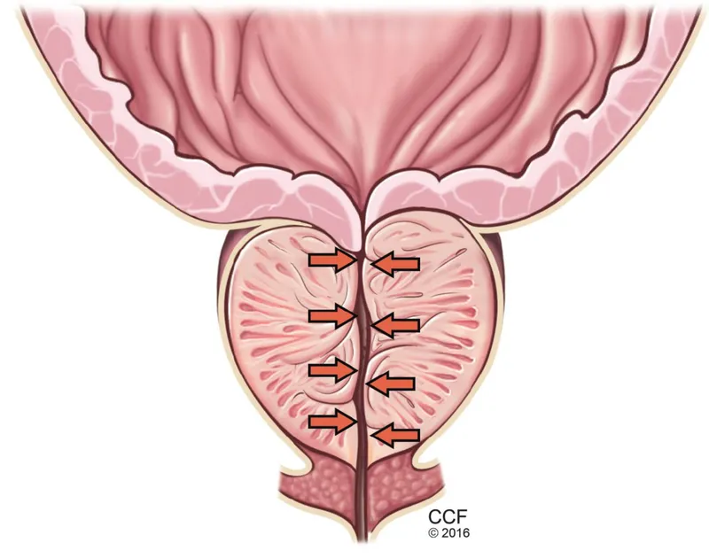 Bladder outlet obstruction from benign prostatic hyperplasia