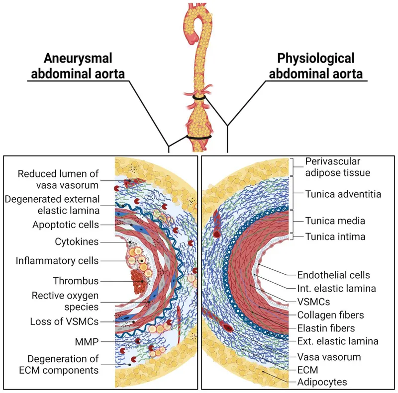 Histology of Aneurysmal vs. Physiological Abdominal Aorta