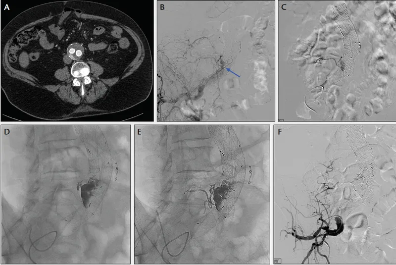 Type II endoleak after EVAR: CT and angiographic views