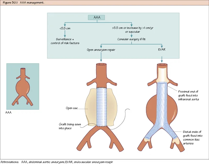 AAA management: Open vs. EVAR repair