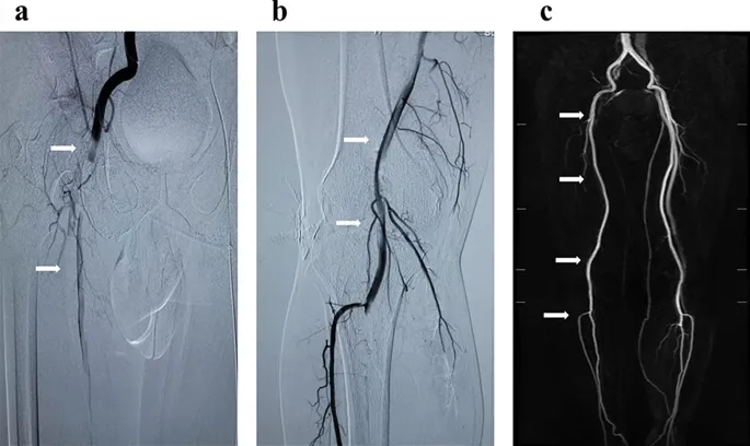 CTA of lower extremity with popliteal artery embolism