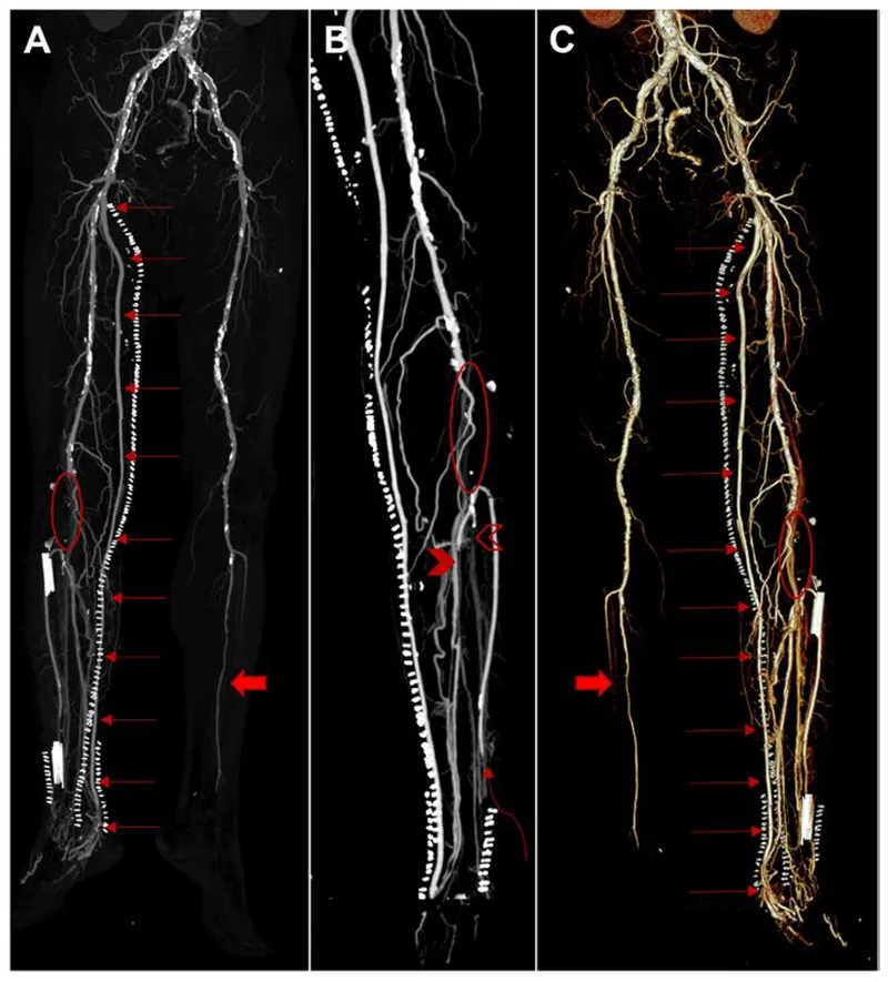 Angiogram of femoral-popliteal bypass graft stenosis