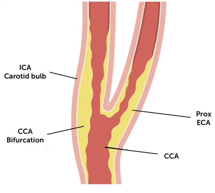Atherosclerotic plaque at carotid bifurcation