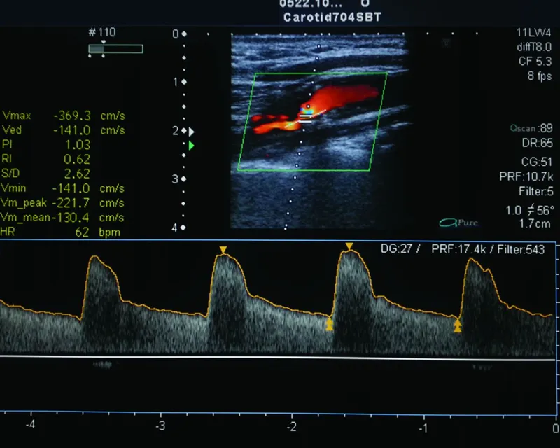 Carotid Duplex Ultrasound with Color Doppler and Stenosis
