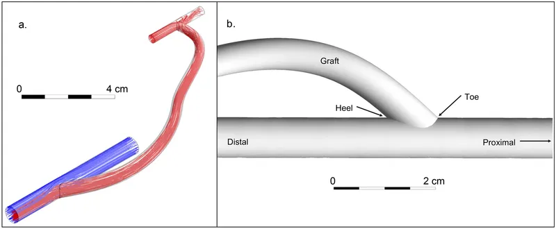 Dialysis Graft Flow Dynamics and Anastomosis