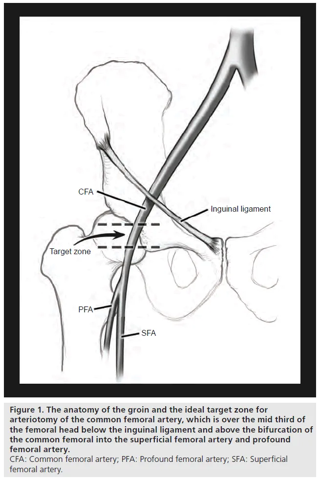 Femoral artery access site for endovascular procedures