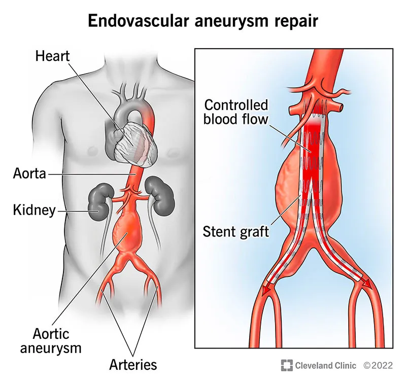 Endovascular aneurysm repair (EVAR) stent graft diagram