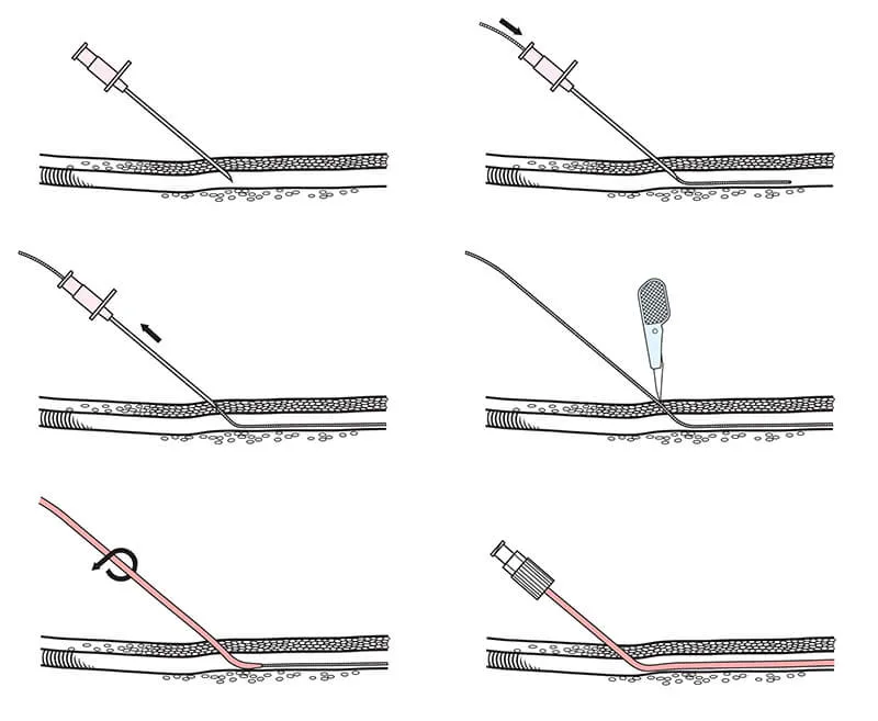 Seldinger technique for vascular access
