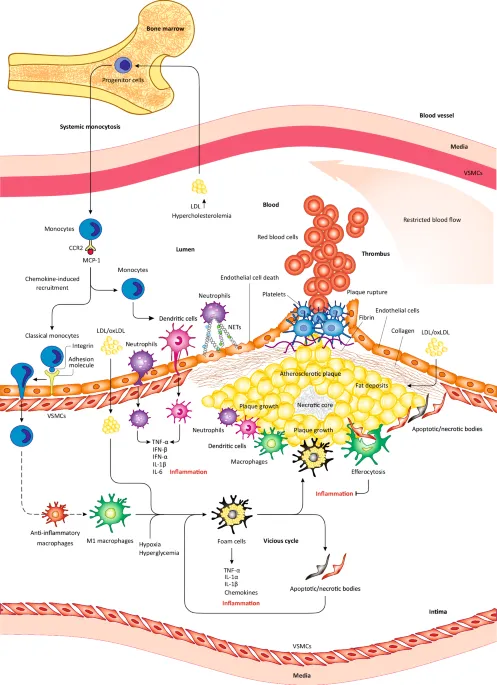 Atherosclerosis pathophysiology with plaque formation