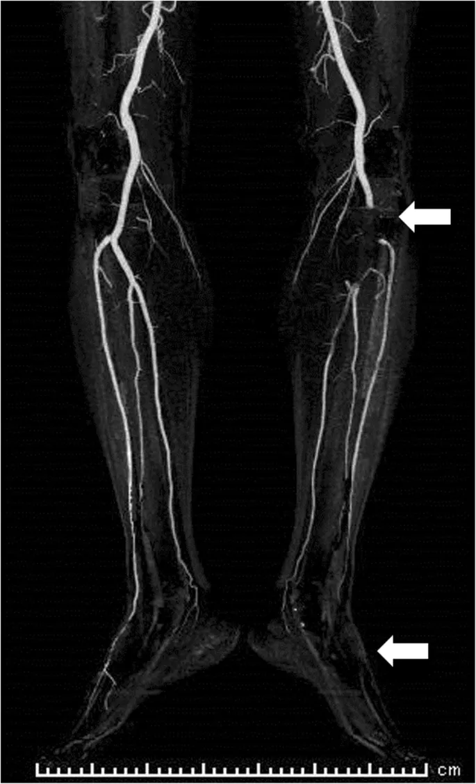 CT Angiography: Acute Limb Ischemia with Popliteal Occlusion