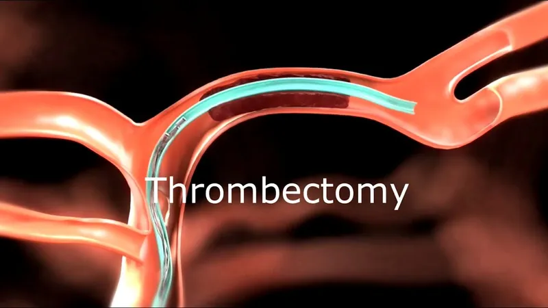 Thrombectomy procedure with catheter