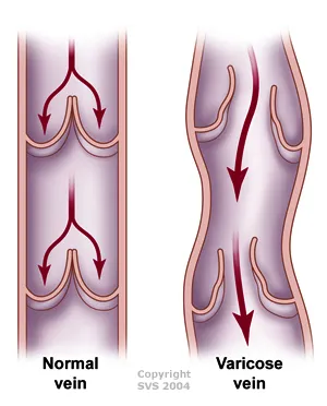Normal vs. varicose vein with valvular insufficiency