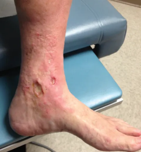 Venous stasis ulcer on medial malleolus