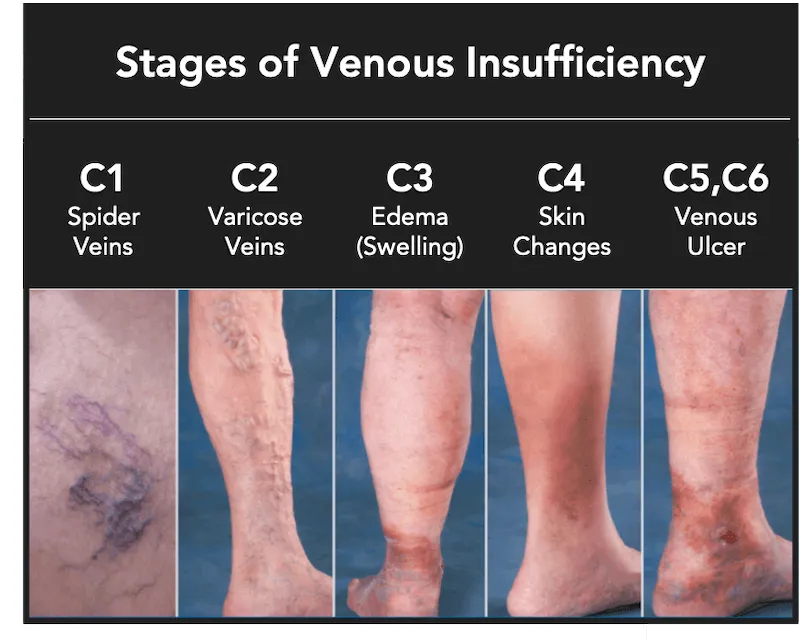Stages of Venous Insufficiency (C1-C6)