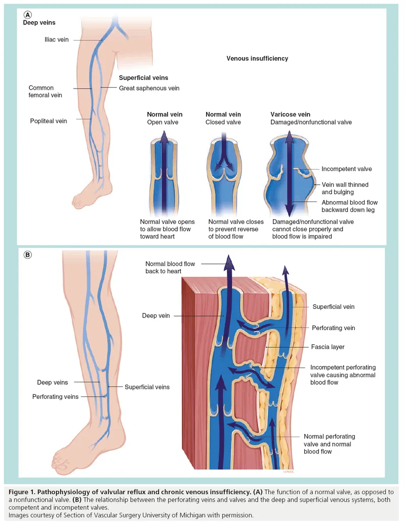 Venous valve incompetence and chronic venous insufficiency
