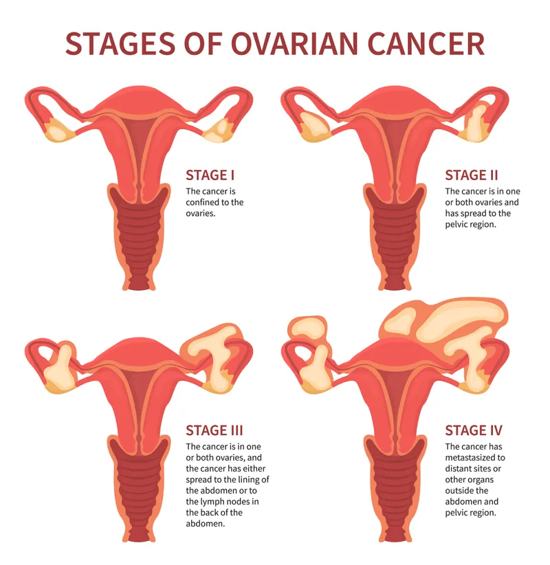 FIGO staging diagram showing progression from Stage I to Stage IV across different gynecologic cancers