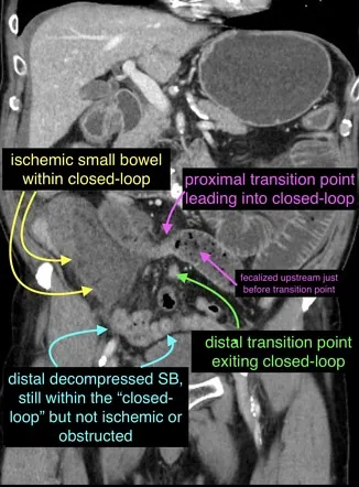 CT scan showing bowel obstruction with surgical planning markers