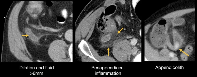 CT scan showing acute appendicitis with appendicolith and inflammation