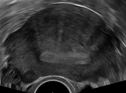 Figure 1: Transvaginal ultrasound showing thickened endometrium measuring 16mm