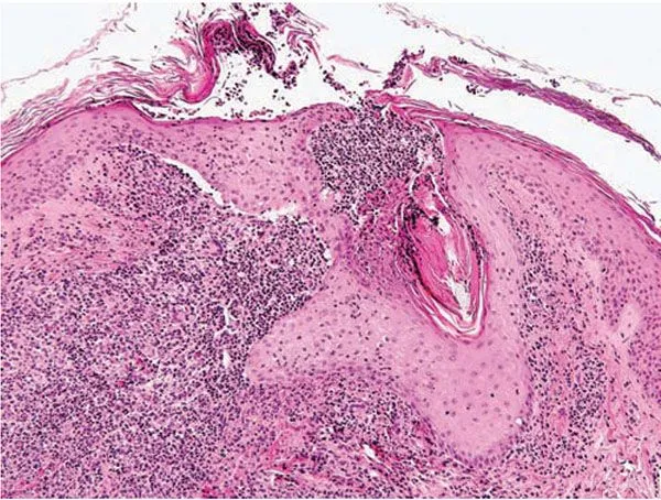 Histological cross-section showing inflammatory infiltrate in acne lesion