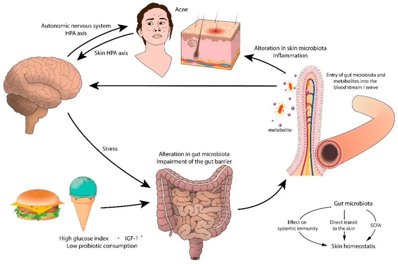 Systems biology diagram showing acne pathogenesis network interactions