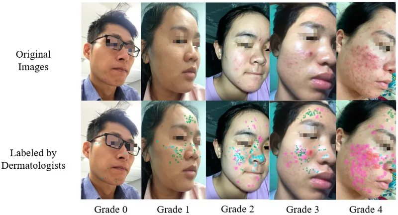 Quick reference chart for acne severity assessment and treatment selection