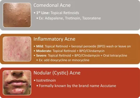 Clinical spectrum of acne vulgaris from comedonal to severe inflammatory