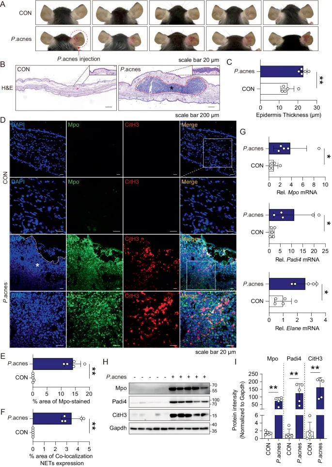 Confocal microscopy showing neutrophil infiltration in acne pustule