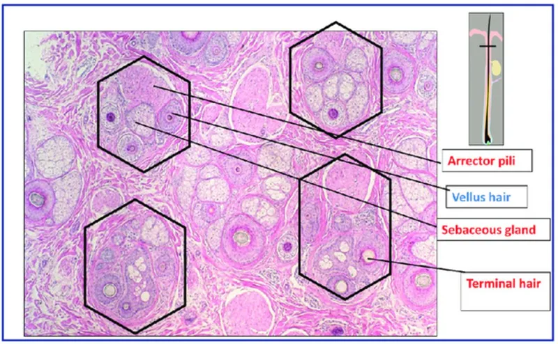 Detailed anatomy of pilosebaceous unit showing sebaceous gland and hair follicle