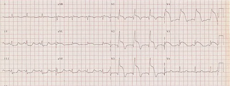12-lead ECG showing anterior STEMI with ST-elevation in leads V1-V6