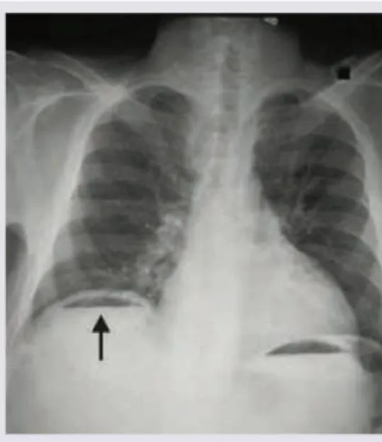 Figure 1: Erect chest X-ray showing crescent of free air under right hemidiaphragm indicating bowel perforation