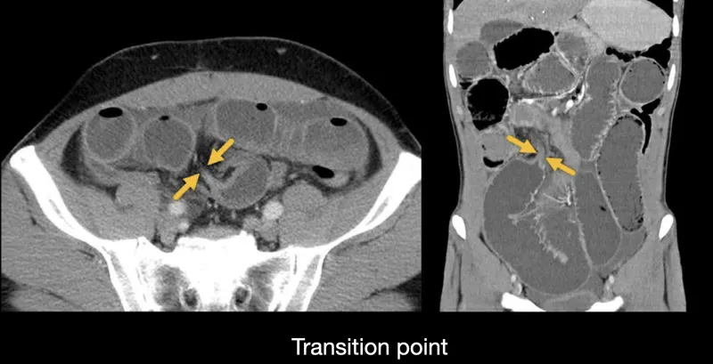 Figure 2: CT abdomen showing dilated small bowel loops with transition point and collapsed distal bowel indicating small bowel obstruction