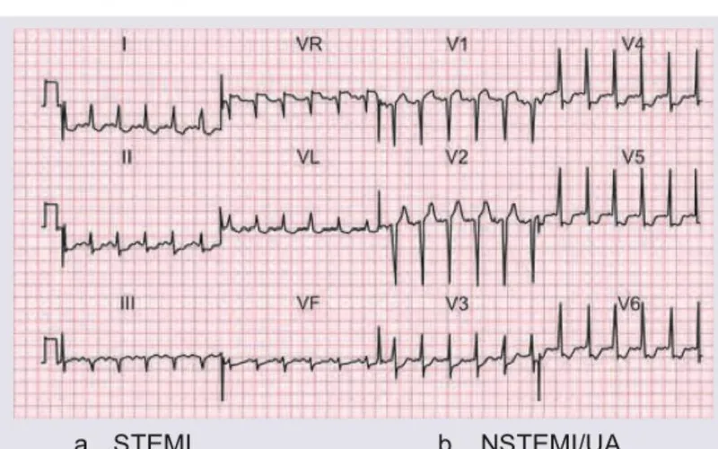 Figure 1: ECG showing ST elevation in leads II, III, and aVF with reciprocal depression