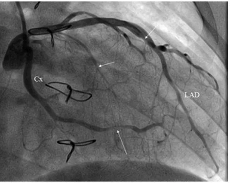 Figure 2: Coronary angiogram showing complete occlusion of left anterior descending artery