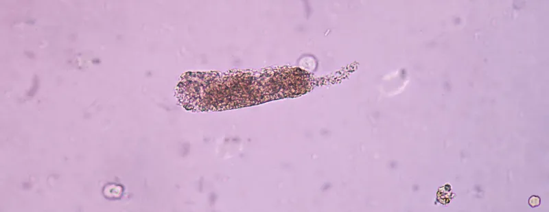 Figure 1: Urine microscopy showing muddy brown granular casts