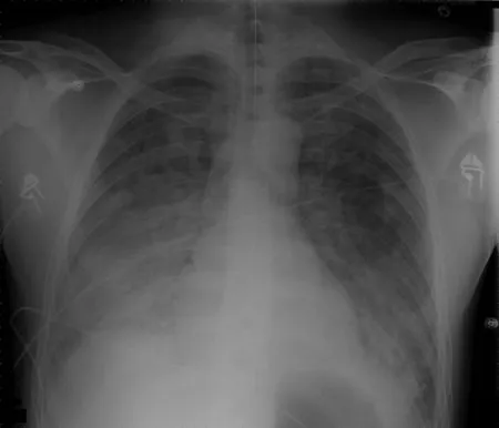 Figure 1: Chest X-ray PA view showing bilateral pulmonary infiltrates with air bronchograms in ARDS secondary to sepsis