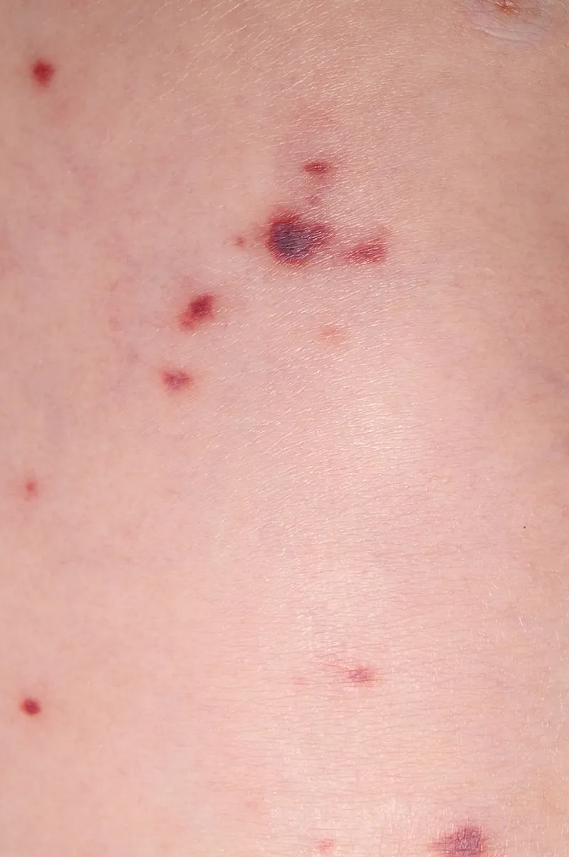 Figure 3: Petechial rash on child's leg showing non-blanching purple spots against pale skin