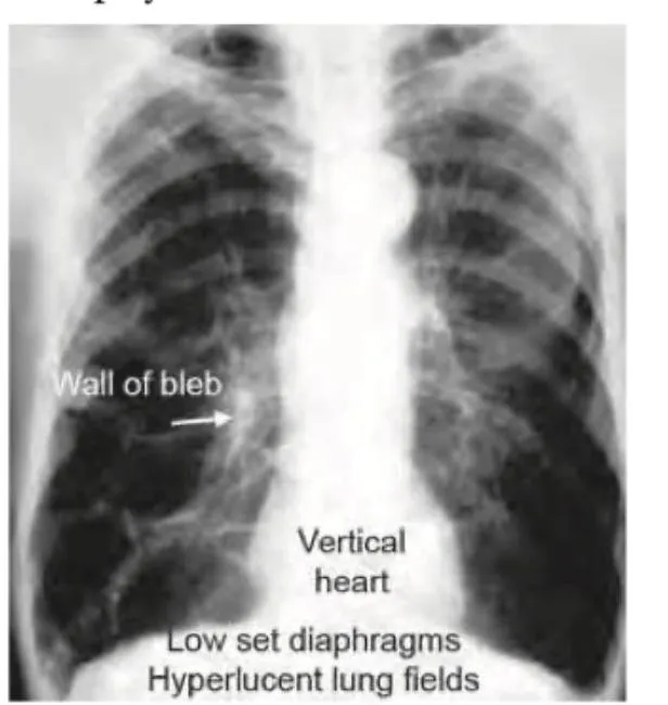 Figure 1: Chest X-ray showing hyperinflated lungs with flattened hemidiaphragms