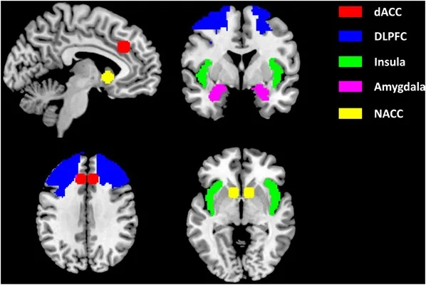 Brain imaging showing craving-related activation in anterior cingulate and insula