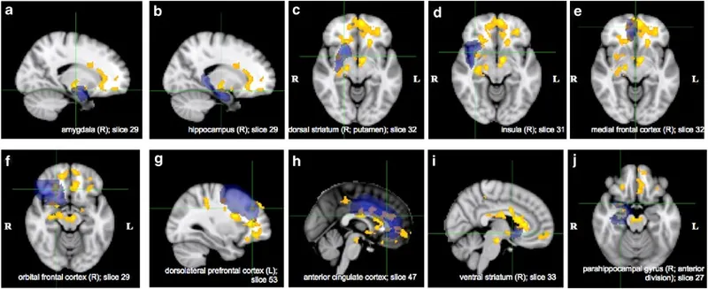 Conditioned craving response showing cue-induced brain activation patterns