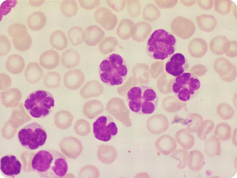 Figure 2: Blood film showing macrocytic red cells with hypersegmented neutrophils pathognomonic of megaloblastic anaemia