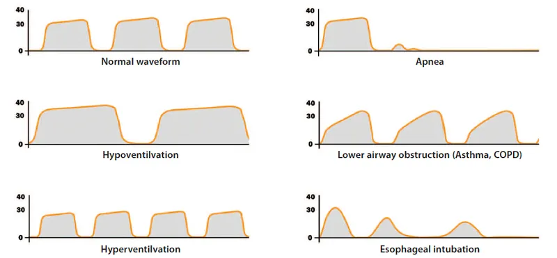 Capnography waveforms showing normal and abnormal patterns