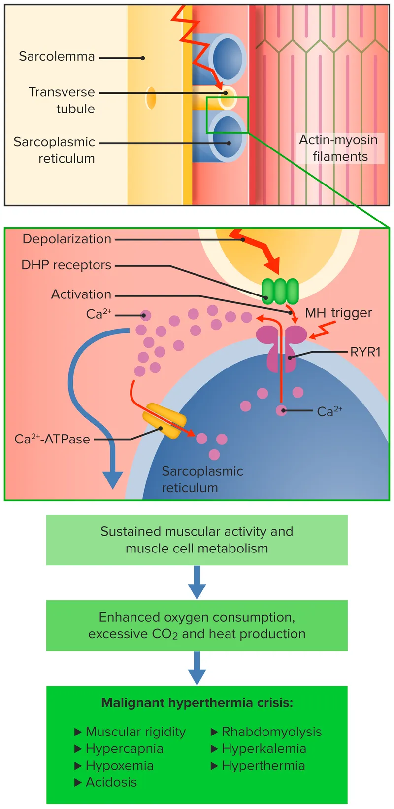 Malignant hyperthermia pathophysiology diagram showing calcium release