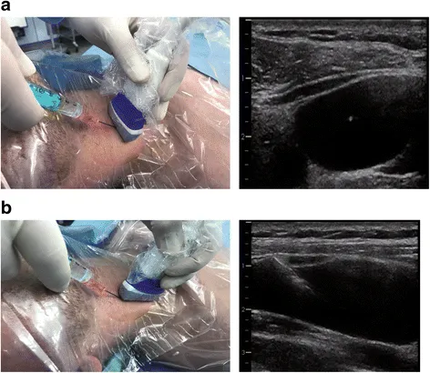 Central venous catheter insertion with ultrasound guidance for emergency monitoring