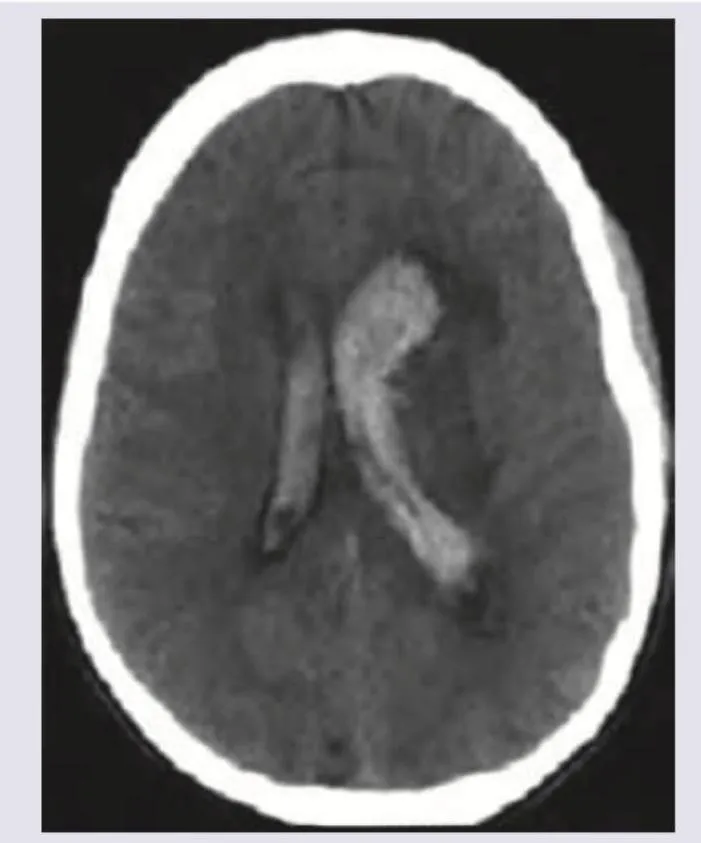 Figure 1: CT brain showing acute intracerebral haemorrhage with mass effect