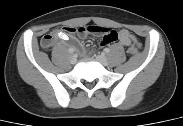 Figure 1: CT scan showing dilated fluid-filled appendix with periappendiceal fat stranding