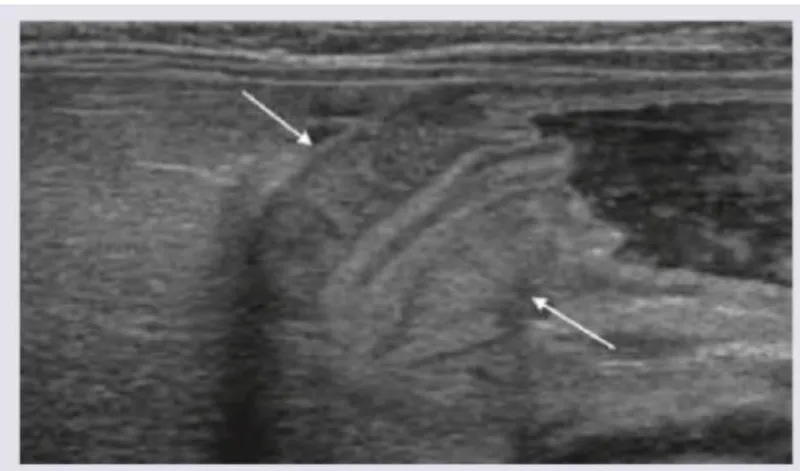 Figure 2: Ultrasound showing non-compressible appendix with target sign appearance