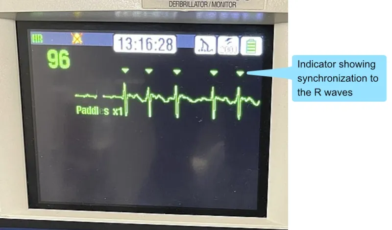 Defibrillator paddles positioned for cardioversion with synchronized mode