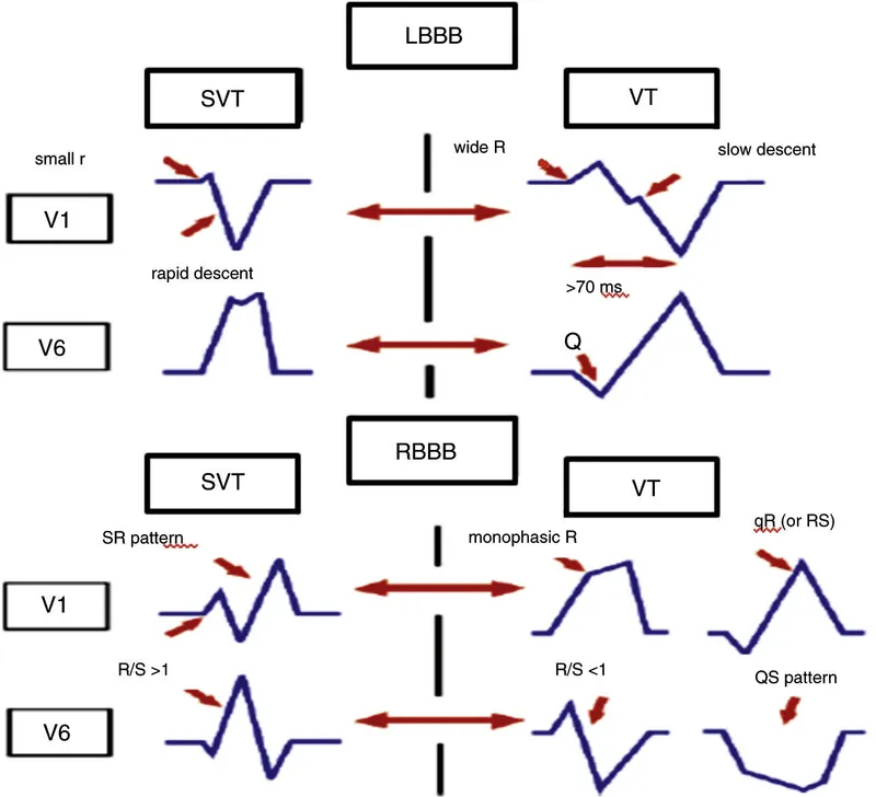 Wide complex tachycardia ECG showing ventricular tachycardia morphology