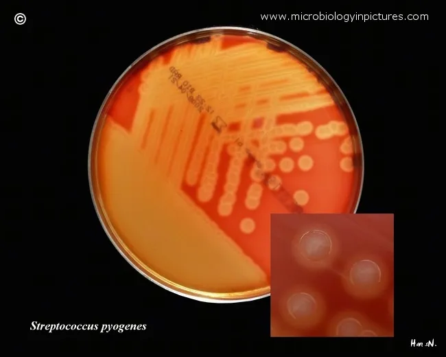Bacterial culture plate showing beta-hemolytic streptococcus colonies